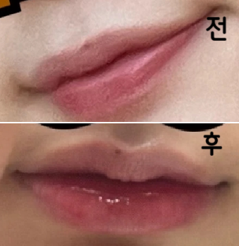 친절하게 잘 해주셨습니다! 붓기랑 멍도 없었어요!!