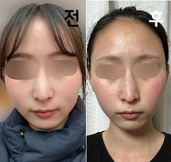 시술 5일 후쯤 시술 받은 사실을 모르는 친구들에게 "살 빠졌어? 얼굴이 작아졌어." 라는 말을 들었어여