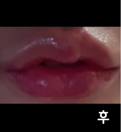 아주 이쁩니다! 다른데서 1cc 맞고 추가로 맞은건데 삐뚤했던 모양 다 교정됨~