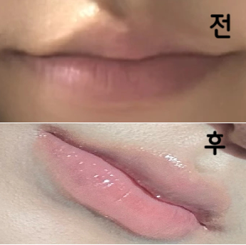 맞고 2일 뒤면 붓기 빠지는 편이라 예쁘게 자리 잡고 있는 거 같습니당~