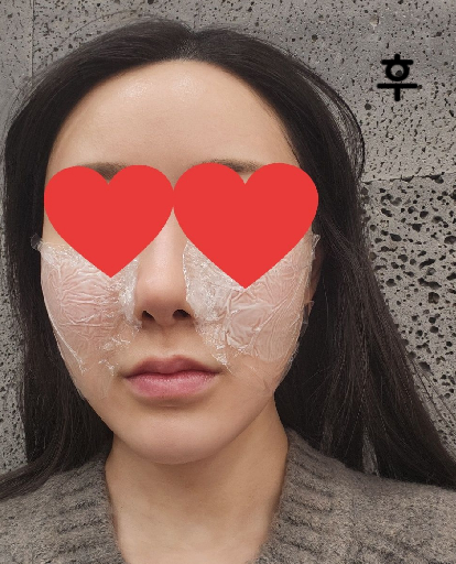 롤리팝은 입술필러도 이쁘게 놔주고 얼굴도 그렇게 여튼 필러 맛집임~~~