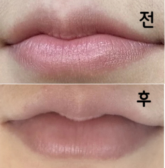 시술할 때 원장님이 물어보면서 필러 넣어주시고 섬세하게 잘 넣어주십니다~~