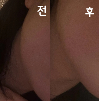 저번에도 왔었고 이번에 또 시술 받았습니당~