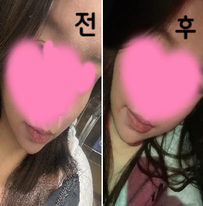 살 빠졌다는 소리 많이 들어요 ㅎㅎ 또 맞으러 갈 것 같아요!!
