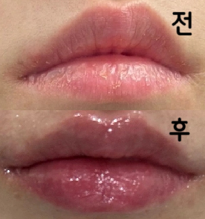 입술필러 엄청 겁내고 갔는데 상담도 시술도 다들 너무 친절하게 알려주셔서 감사했어요 ㅎㅎ