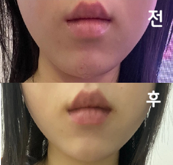 좀 갸름해졌다구 하네요 2/3회차도 맞아보렵니다~