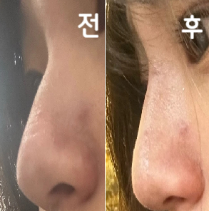 제코에 어울리게 맟춰서 해주셨고 비용도 그대로였어요. 모든 분들이 친절하셔서 기분 좋게 받고 왔습니당~