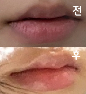 입술필러 맞는 게 처음이라 덜덜 떨면서 갔는데 너무 친절하셨구 너무 이쁘게 잘 된 거 같아용~