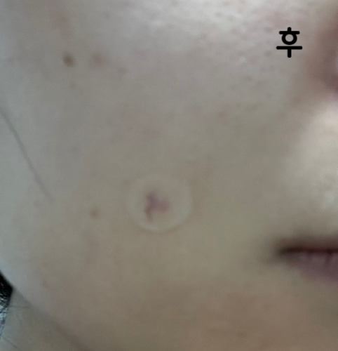 원장님 설명 잘 해주시고 진짜 꼼꼼하세요! 덕분에 시술 잘 받았습니다~