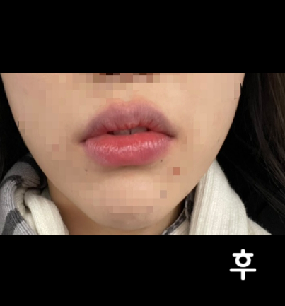 다른 시술 권유도 안하시고 필요한 부분만 딱 시술 해주셔서 좋았어요!