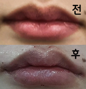마취를 해서 아프지 않았어요! 너무 귀여운 입술 get입니다 ♥