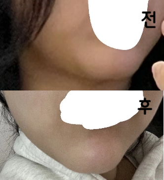 심부볼 위주로 받고 싶다고 추가적으로 의사선생님께 말씀드렸더니 심부볼에 집중적으로 놔주셔서 좋았어요!!