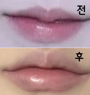 입술이 얇아서 늘 필러 고민이 있었는데 많이 알아보다 후기가 좋아 찾아가게 되었어요!