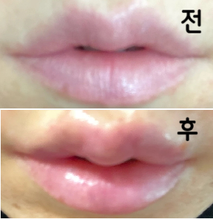 의사선생님께서 다시 한 번 입술 모양 설명 해 주시면서 원하는 모양 잡아주셨어요~ 친절하시고 좋았어요~