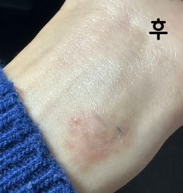 좋아요! 원장님이 꼼꼼하게 시술해주셔서 만족도가 높아요!