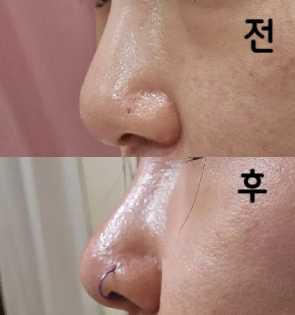 기존 필러 퍼짐개선과 재시술 목적이었는데 시술은 아팠지만 꽤 마음에 들었어요!
