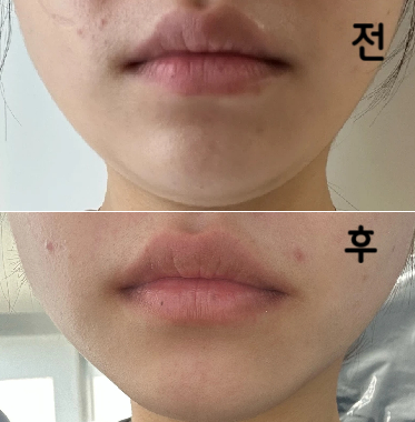 다이어트랑 병행하니 2주차 효과 많이 봤어요~ 또 맞으러 갈 의향 100프로!