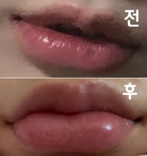 대표원장님께 받았는데 원장님 엄청 친절하셨어요 전체적으로 만족스러웠고 재방문 의사 너무너무 있어용 ♥