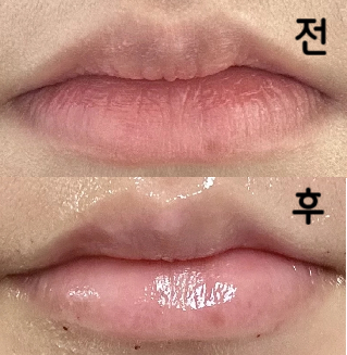 입술필러 처음 맞아서 걱정됐는데 친절하세 설명해주시고 중간중간 계속 물어봐 주셔서 원하는 모양에 가깝게 시술 된 것 같아요!