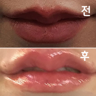 상담도 매우 정성스럽고 통역도 유창하고 기술도 너무 좋아서 만족스러운 클리닉이었습니다!