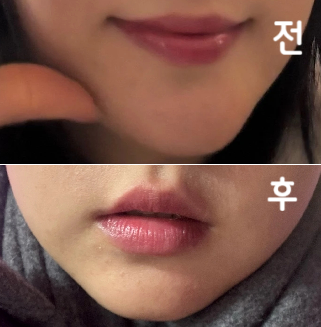 필러 녹이러 가고 싶었는데 엄청 친절하시고 너무 잘 설명해주셨습니당~!