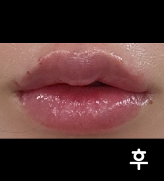 원장님께서 입술 두께 수시로 체크해주시고 직원분들 엄청엄청 친절하셔서 다시 가고싶게 만들어 주시네요.. 굿굿