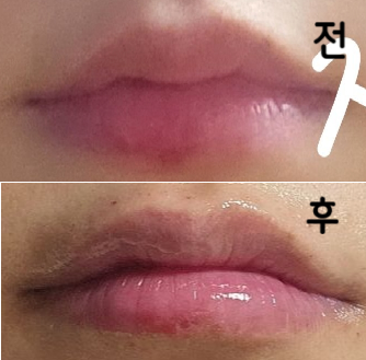 윗입술 맞을 때 정말 아픈데 맞고 나니까 하길 잘 했다는 생각이 들어요 ㅎㅎ