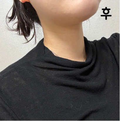 지방분해주사는 항상 여기로 가요 굿굿 만족합니다!!
