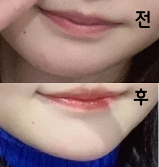 턱 끝 필러 시행했습니다! 너무 뾰족하지 않게 자연스럽게 부탁드리고 원하는대로 해주셨어요!! 만족합니다!