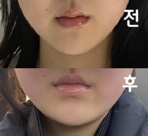 여자선생님이 주사해주셨어용! 궁금한거 물어보니까 친절하게 답해주십니다 ㅎㅎ
