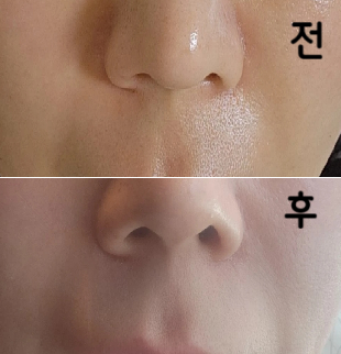 스킬 너무 좋으시고 필러 잘 녹았어요! 너무 만족합니다!!