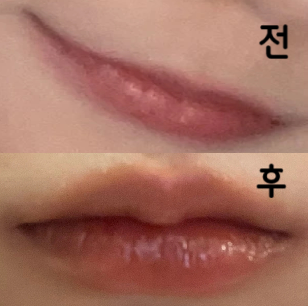 많이아플까봐 걱정했는데 너무 안 아팠고 더 통통해지고 싶어서 리터치 꼭 하러 갈거임~~