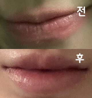 입술필러 맞아봤는데 너무 자연스럽게 돼서 만족해요!! 처음이라면 여기서 하는 거 추천해요!