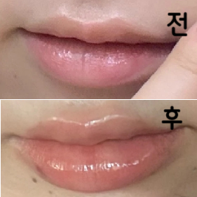 처음으로 입술필러 받아봤는데 너무 맘에 들어여,, 원장님 친절하시고 편하게 시술 받을 수 있었어용!