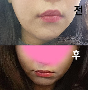 이제 일주일 정도 됐는데 살도 안 빠졌는데 갸름해보인대용! 3주 뒤에 또 포키주사 맞으려구용~