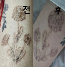 현 상태 설명 꼼꼼하게 해주시고, 그에 따라 레이저를 어떻게 작용할건지 다 설명해주세요! 완전 꼼꼼&친절합니다!