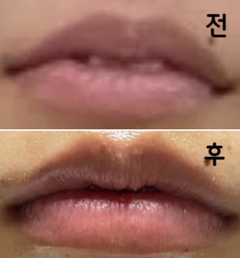 입술에 볼륨이 별로 없고 얇아서 당일 날 필러 받으러 갔는데 고민한 시간이 아까웠어요ㅠㅠ
