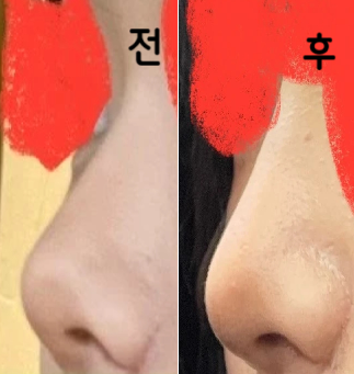 잘 봐주시고 결과는 맘에 들어요! 확실히 콧대가 생겼는데 사진으론 티가 잘 안나네요~