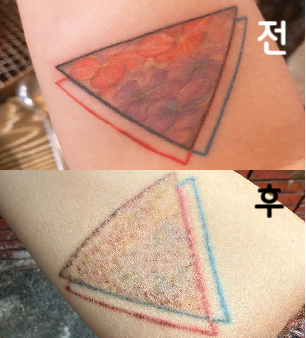 시술 끝나고 간호사님도 관리방법 상세하게 알려주셔서 좋아요! 다음번에 또 올것임!!!