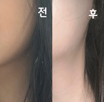 2주 전에 맞고 몇 번 더 해야 좋다고 하길래 한 번 더 맞으러 왔습니다! 이번에도 꼼꼼하게 놔주시고 정말 친절하셨습니다 ㅎㅎ