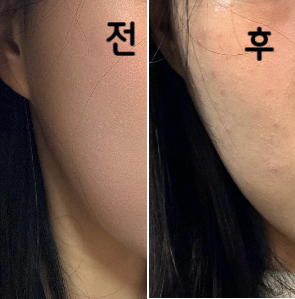 효과가 좋아서 더 맞을생각이에요~