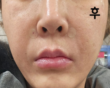 저는 대표원장님께 필러 시술 받았는데 한 부위 시술 끝날 때마다 거울 직접 보게하여 부족한 부분 다시 채워주셨어요~ 만족합니다!