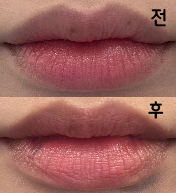 필러가 빠르고 확실하게 녹아요! 감사합니다!