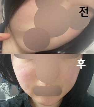 대기는 좀 길었지만 안 아프게 잘 해주셨어요~