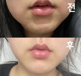 다른 곳에서도 맞아봤는데 여기만큼 안 아픈 곳은 없었어요!! 의사쌤도 친절하시고 다음에 또 방문할 예정입니다!