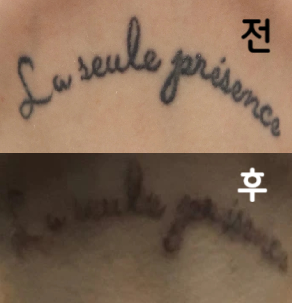 여러번 신세 지고 있어요! 처음에 비하면 많이 지워져서 별로 신경 쓰이지 않을 정도입니다!! 항상 감사합니다!!