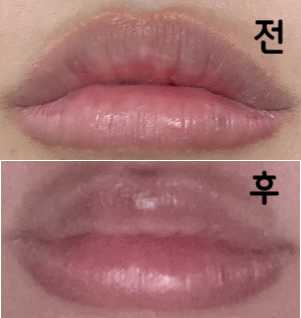 제 인생 두 번째 입필입니다 첫 번째 맞았을 땐 너무 자연스럽게 맞아서 이번엔 좀 내 스탈대로 맞았어용~