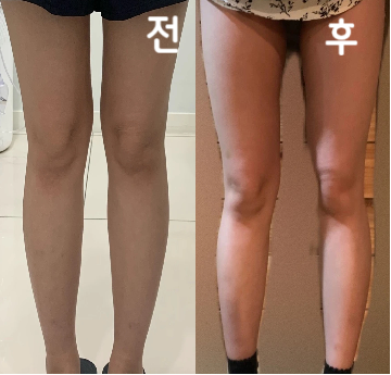 조금가늘어진 것 같은 느낌? 극적인 변화는 느끼지 못했지만, 특별히 큰 어려움도 없었습니다!