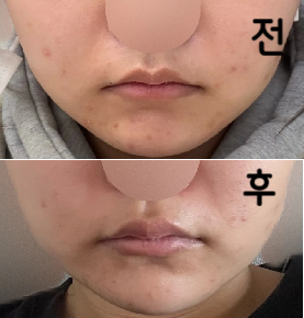 원래 지방분해주사를 맞던 병원보다 훨씬 가격이 저렴했고 용량도 많이 넣어주셨어요!