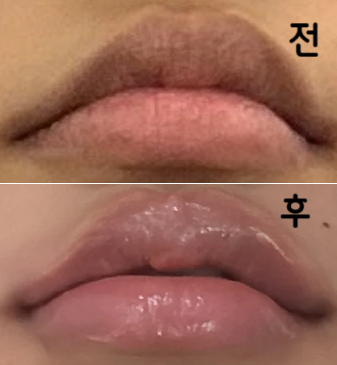 날이 갈수록 제 입술처럼 자연스럽게 입꼬리 올라가고 주름도 펴져서 너무 좋았어요!!